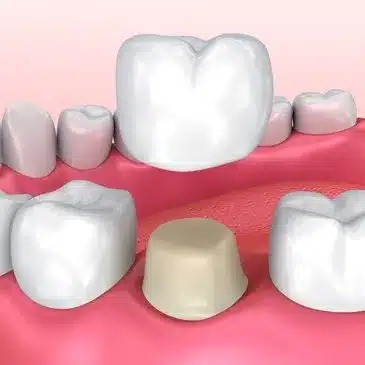 3D dental illustration showing tooth crown placement among natural teeth on pink gum model.