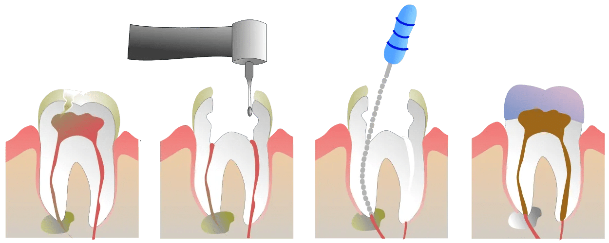 Dental procedure steps showing tooth extraction and root canal treatment progression with instruments.