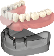 Dental implant model showing prosthetic teeth attachment to jawbone structure for restoration.