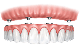 Dental implant bridge prosthetic showing pink gum model above white tooth crowns.