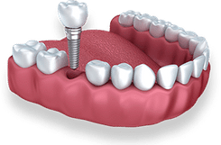 Dental implant model showing artificial tooth replacement in gum structure with crown and fixture.