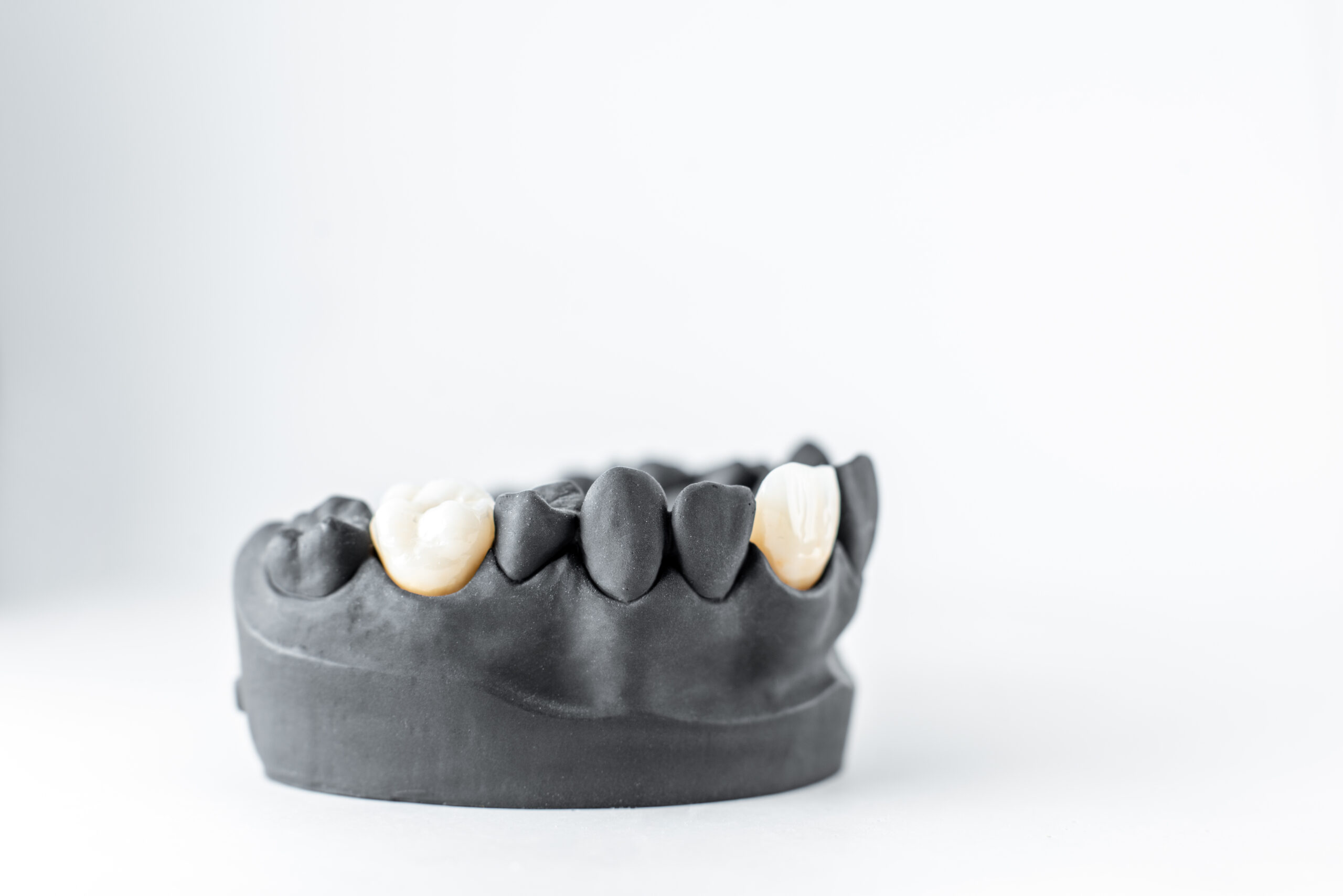Dental Crowns in Flint: Broken Tooth Guide